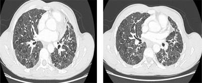 Case Report: Gold Miner’s Lung: A Case of Chronic Hypersensitivity Pneumonia in Amazonian Forest
